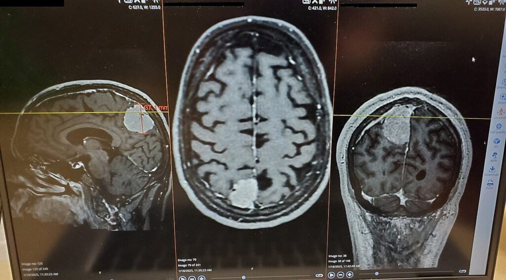 Sieć neuronowa wykrywa na MRI ślady padaczki i stwardnienia rozsianego Sieć neuronowa wykrywa na MRI ślady padaczki i stwardnienia rozsianego